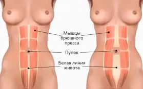 Пластика живота до и после
