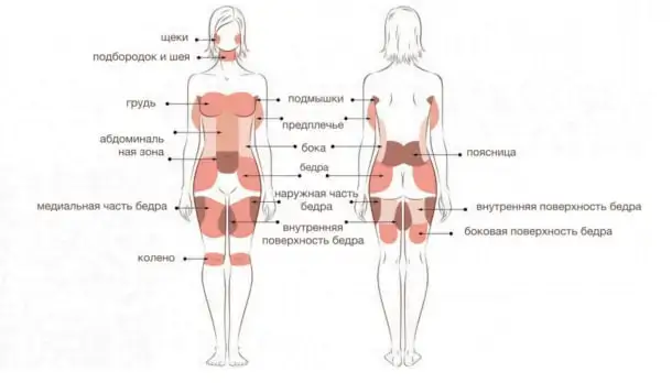 Липосакция жировых ловушек до и после